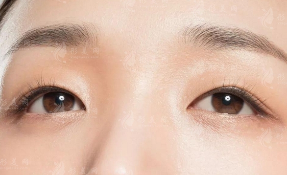 雙眼皮手術(shù)后：如何區(qū)分肉條與腫脹