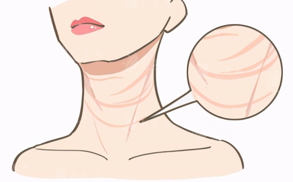 激光祛除頸部皺紋后:護(hù)理與注意事項(xiàng) 激光祛除頸部皺紋后:護(hù)理與注意事項(xiàng)