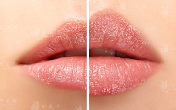 玻尿酸豐唇用量的決定因素探討