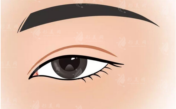 西京醫(yī)院做全切雙眼皮多少錢？熱門醫(yī)生、案例、收費價格表