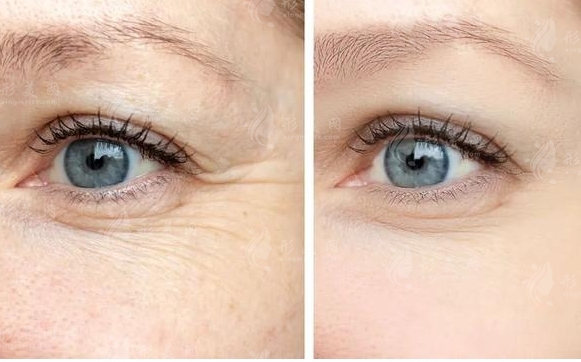 注射玻尿酸去除魚尾紋的優(yōu)勢及效果持續(xù)時間 注射玻尿酸去除魚尾紋的優(yōu)勢及效果持續(xù)時間