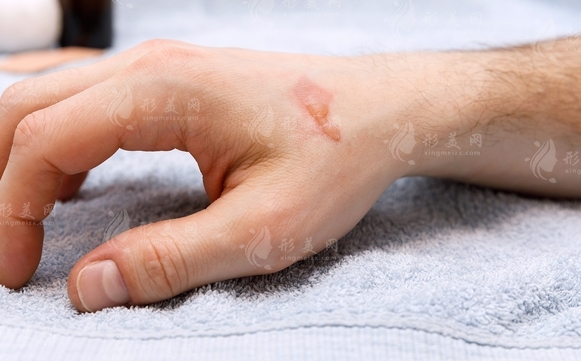 激光去疤痕能恢復(fù)到什么程度?較好時間揭秘