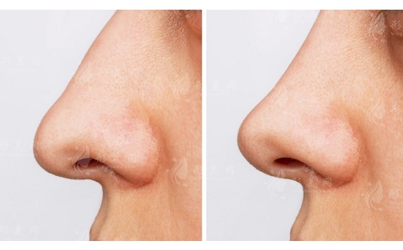 硅膠隆鼻去除率高嗎?及注意事項(xiàng) 硅膠隆鼻去除率高嗎?及注意事項(xiàng)