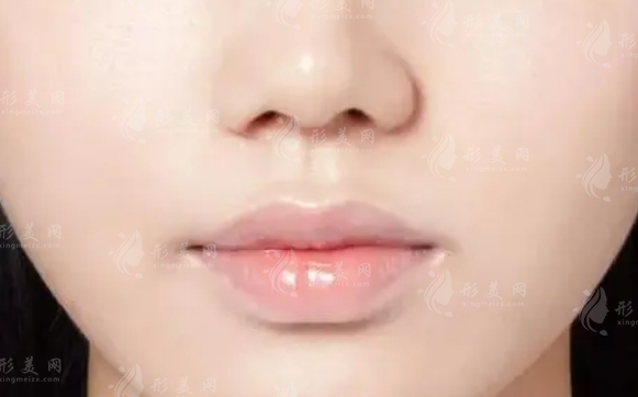 玻尿酸豐唇后的持久飽滿秘籍