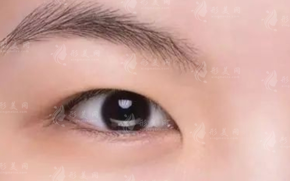 不同類型的腫眼泡及其調節(jié)方法