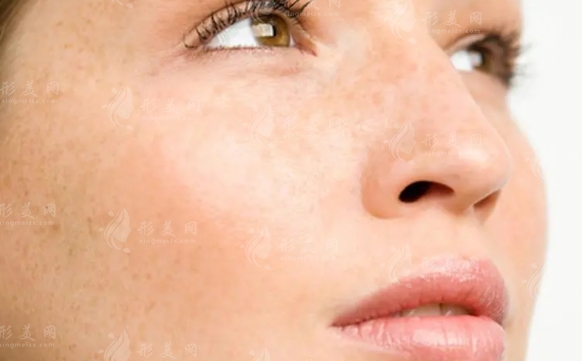 臉上黃褐斑難去除？這些淡斑祛斑方法或許能幫到你