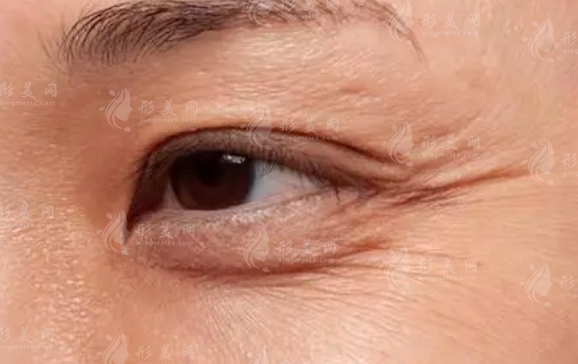 激光去除魚尾紋:效果與副作用的全面解析 激光去除魚尾紋:效果與副作用的全面解析