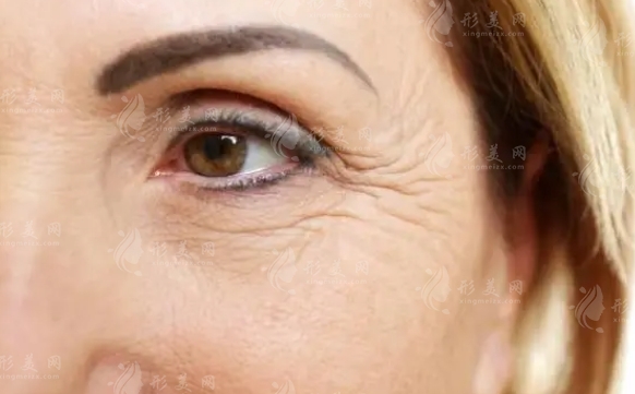 激光去魚尾紋：一種現(xiàn)代美容技術的深度解析