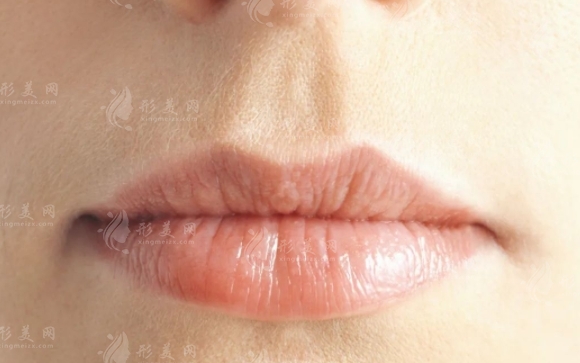 玻尿酸豐唇是否會溶解？豐唇后有哪些注意事項？