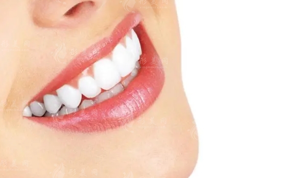 牙齒冷光美白:維持時間與副作用探討 牙齒冷光美白:維持時間與副作用探討