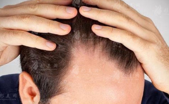 發(fā)際線(xiàn)種植可以維持多久？了解這些避免踩雷！