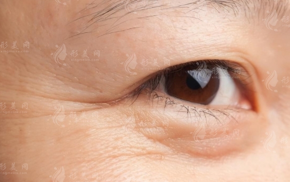 自體脂肪填充眼周皺紋:優(yōu)勢與注意事項(xiàng) 自體脂肪填充眼周皺紋:優(yōu)勢與注意事項(xiàng)