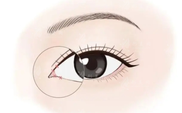 開(kāi)眼角術(shù)后又恢復(fù)原型怎么辦？應(yīng)采取哪些措施？