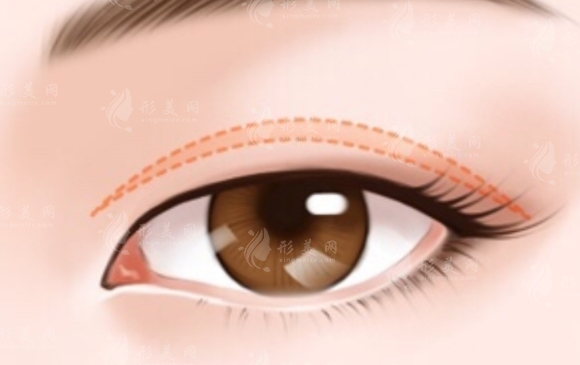 三點(diǎn)定位雙眼皮與埋線的區(qū)別