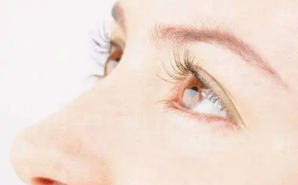 埋線雙眼皮：能維持幾年？可以做第二次嗎？