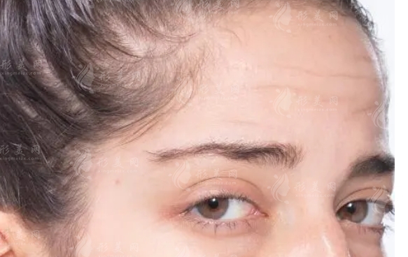 抬頭紋手術(shù)多少錢？一千以內(nèi)可以做嗎？