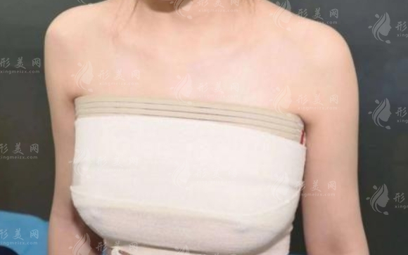 乳暈縮小術(shù)恢復(fù)時間與注意事項(xiàng)