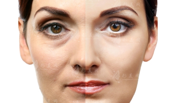 全臉拉皮手術(shù)詳解及術(shù)后護(hù)理指南