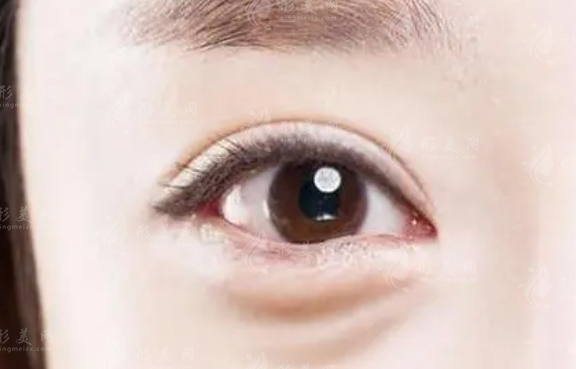 內(nèi)切去眼袋多久恢復(fù)？快恢復(fù)的辦法是什么？