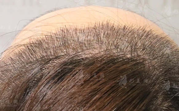 頭發(fā)種植手術(shù)方法概覽：四種植發(fā)方式詳解