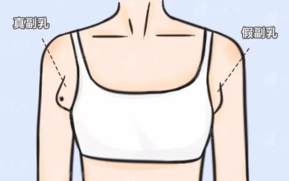 副乳吸脂手術后的恢復時間