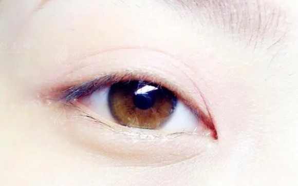 雙眼皮疤痕增生的前兆解析