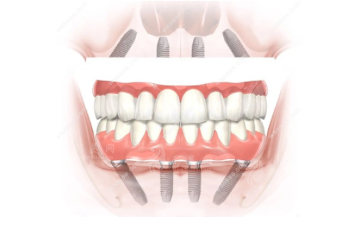 廣州人民醫(yī)院矯正牙齒費(fèi)用多少錢(qián)？項(xiàng)目及牙齒整形技術(shù)優(yōu)勢(shì)分享！