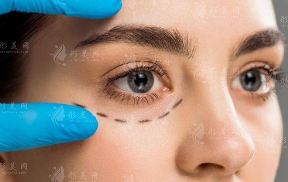 切開雙眼皮能修復(fù)好嗎？修切開雙眼皮要花多少錢？