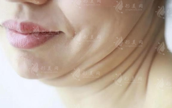 雙下巴抽脂減肥:價(jià)格與效果全面解析 雙下巴抽脂減肥:價(jià)格與效果全面解析