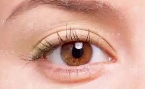 自體脂肪可以填充臥蠶嗎？自體脂肪填充后的注意事項(xiàng)