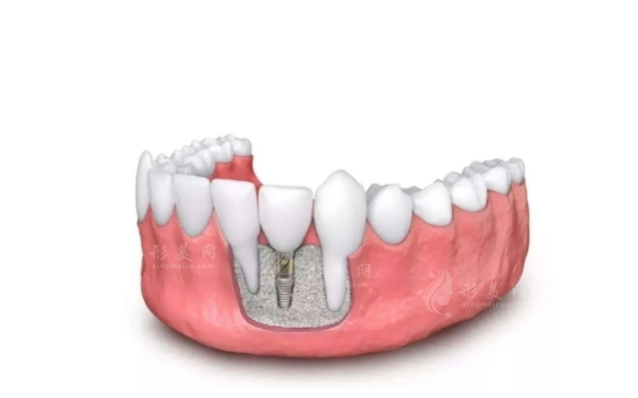 延長種植牙使用年限的關(guān)鍵要素及策略