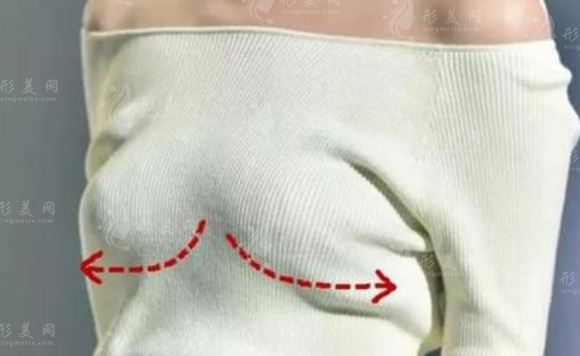 乳房下垂矯正的四種手術方法：你應該選哪一種？