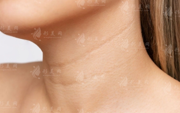 激光去除頸部皺紋：效果顯著與多重優(yōu)勢