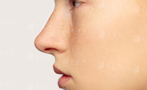 耳軟骨墊鼻尖會(huì)歪斜的原因探析