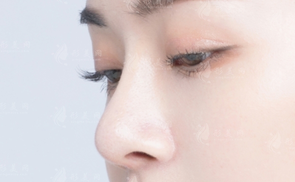 鼻翼外切后腫脹需要多長(zhǎng)時(shí)間才能消退