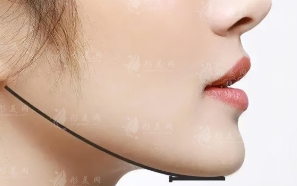 去除下頜角的方法及恢復(fù)時(shí)間