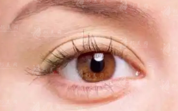 注射玻尿酸豐臥蠶的副作用解析