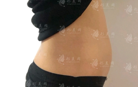 腰腹環(huán)吸會(huì)影響月經(jīng)嗎？及注意事項(xiàng)