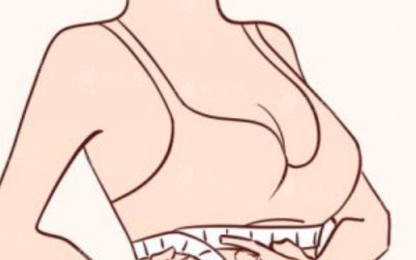 雙平面隆胸與普通隆胸的區(qū)別