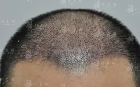 關(guān)于FUE植發(fā)：手術(shù)過(guò)程與注意事項(xiàng)全面解析