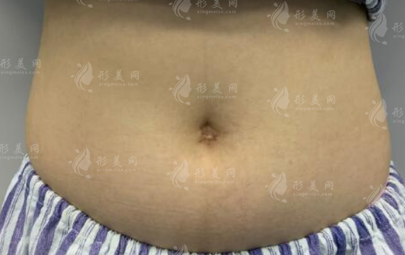 大肚子抽脂有用嗎？效果取決于哪些因素？