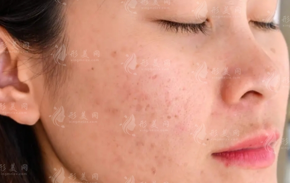 肌膚重生之旅：有效祛除痘印痘疤與修復(fù)凹洞的全方位指南