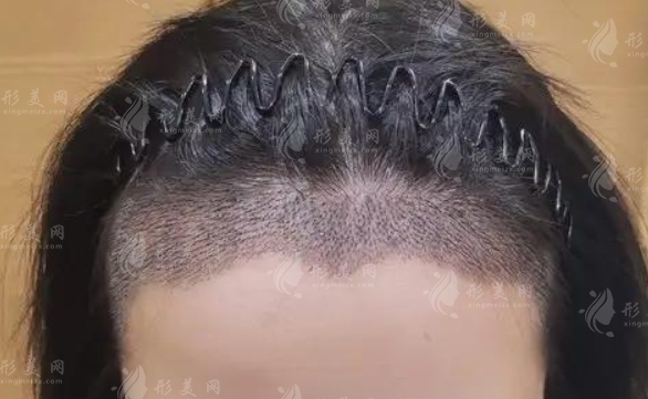 發(fā)際線(xiàn)種植的特點(diǎn)：重塑美麗，自然持久