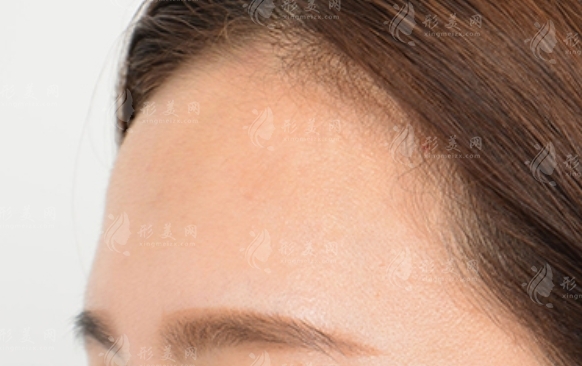 額頭膨體填充的安全性及需考慮的因素