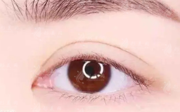 雙眼皮修復(fù)成功率高嗎？什么人適合做？