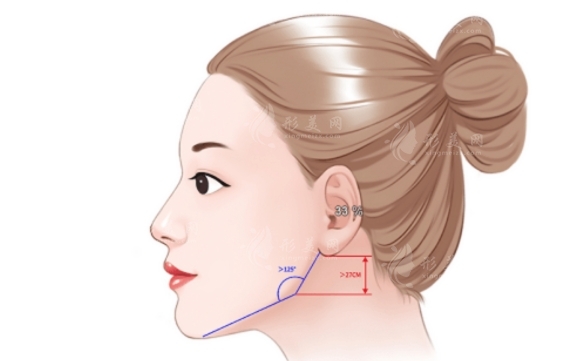 下頜角接骨整形手術(shù)：重塑面部輪廓的藝術(shù)