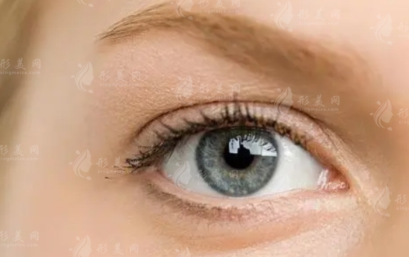 開內(nèi)眼角會(huì)回縮嗎？一起來看看吧