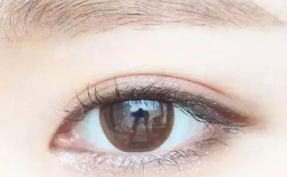 全切雙眼皮術(shù)后眼部清理的重要性