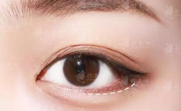 自體脂肪豐臥蠶：是否會(huì)移位及相應(yīng)措施