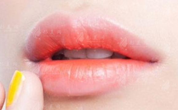 自體脂肪豐唇：多久后可以變自然？